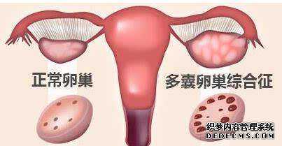 多囊卵巢又如何，不孕多年终于怀孕，分析如何备孕，接好孕的来！